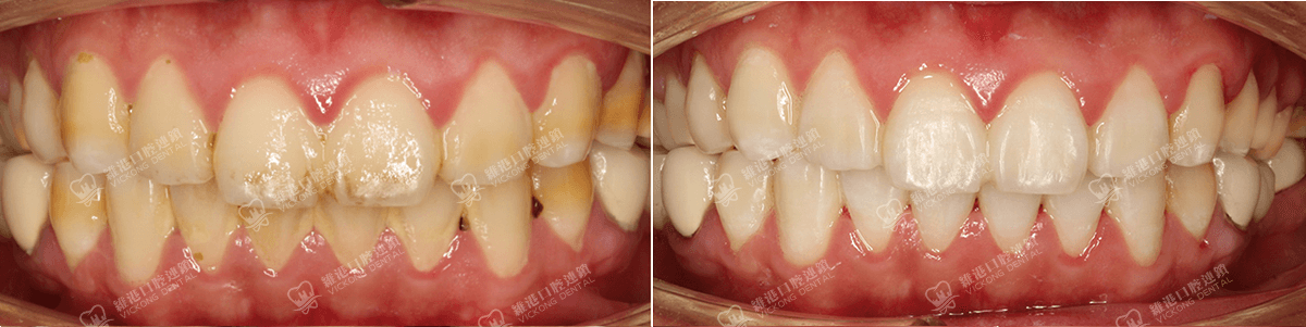 深圳種牙&深圳維港口腔