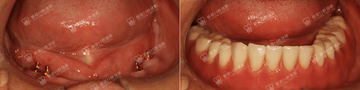 深圳種牙&深圳維港口腔