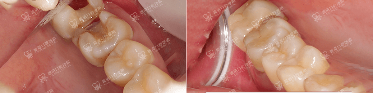 深圳種牙&深圳維港口腔