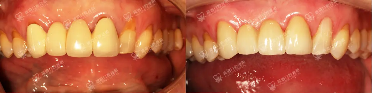 深圳種牙&深圳維港口腔