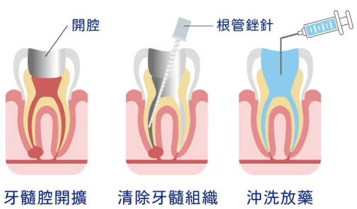 根管治療