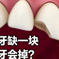 深圳維港口腔邊間好？門牙缺損點樣修復呢？