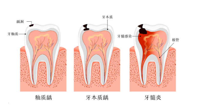 為什麼我的牙髓炎深圳的醫生說得比較嚴重呢？