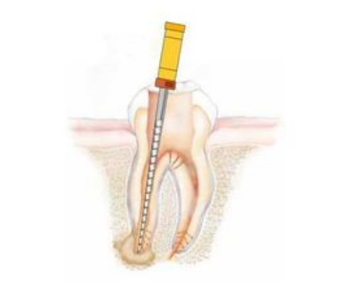 深圳根管治療