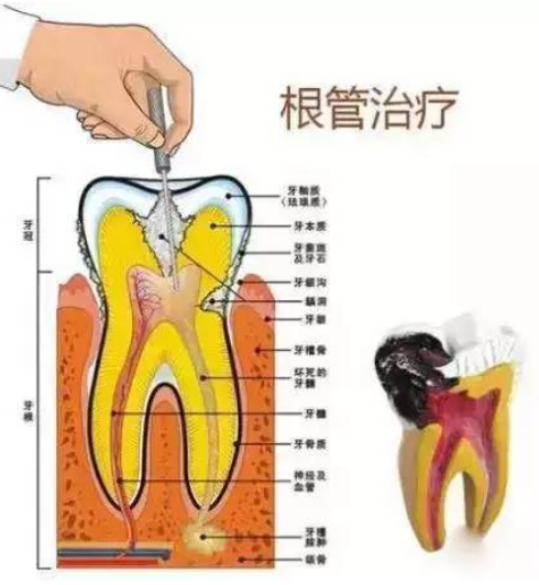 深圳根管治療