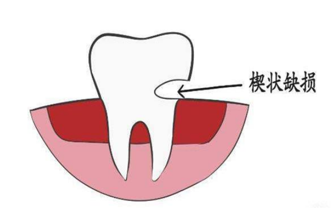 深圳補牙推介，牙齒楔狀缺損系咩原因引起嘅？分幾種情況？ 