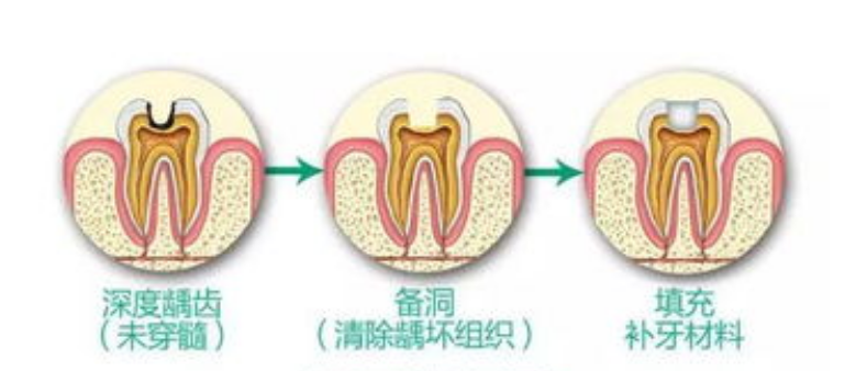 深圳牙醫推介，嵌體嘅使用壽命多久？