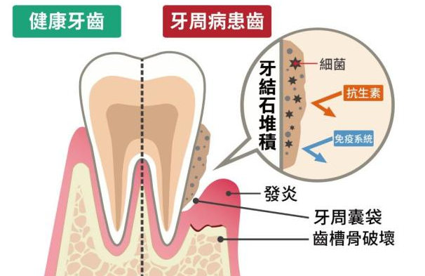 深圳牙周病