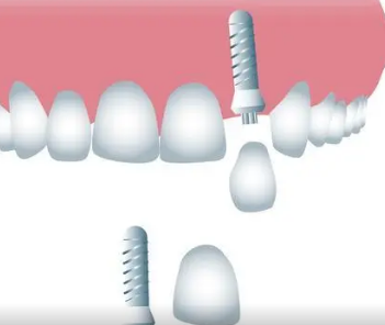種植體牙冠材料有邊啲？深圳維港口腔植牙牙醫推薦？