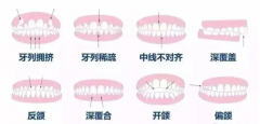 看完這篇深圳牙齒矯正攻略，避開正畸路上的坑！