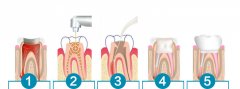 為什麼很多人做根管治療都要去三次以上？