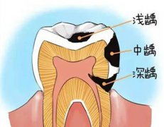 深圳補牙-補牙不及時會有什麼後果？