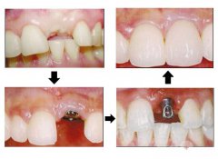 “種植牙＂需要多長時間？有哪些步驟？