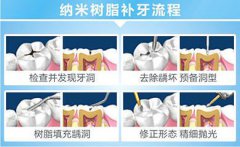 什麼是樹脂充填補牙？