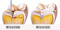 什麼是窩溝封閉，什麼時候做合適？