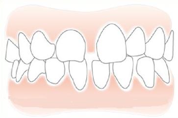 深圳牙科-門牙有縫