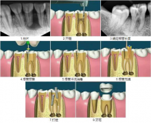 為什麼根管治療中要給牙根反復拍X光片？
