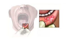 口腔內反復出現小潰瘍是怎麼回事？